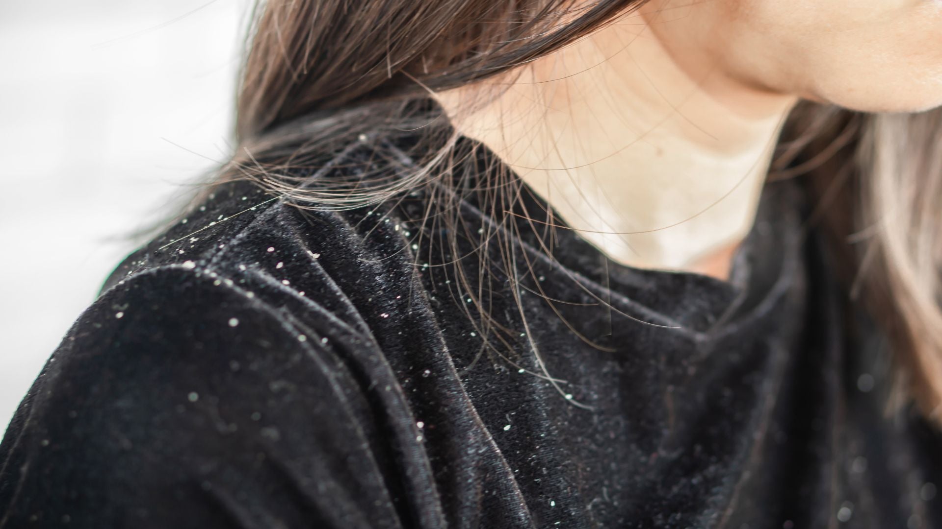 Can Argan Oil Help With Dandruff